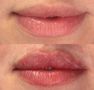 A before and after photo of a woman 's lips.