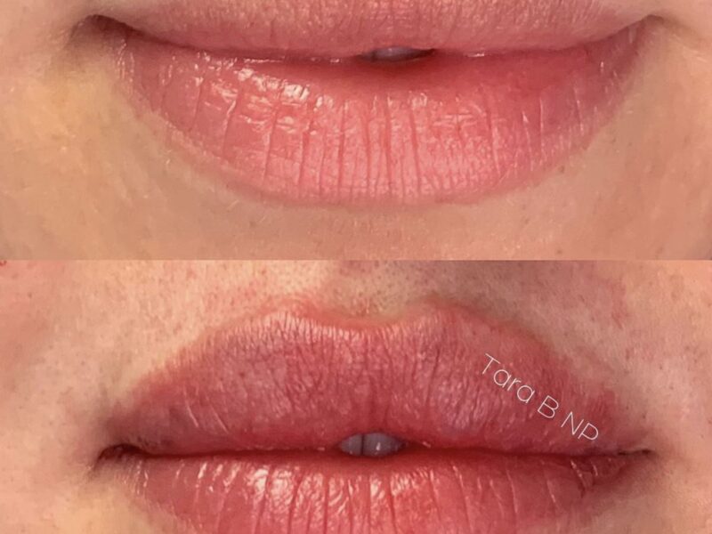 A before and after photo of a woman 's lips.