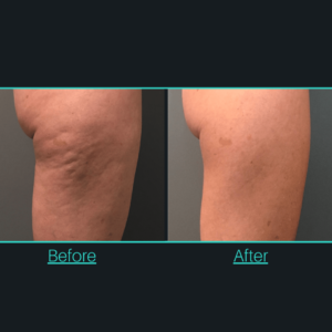 A before and after picture of the legs of someone who has cellulite.