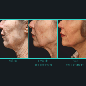 A woman 's face before and after treatment.