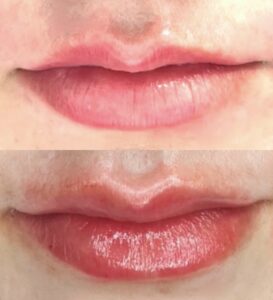 A before and after picture of the lips