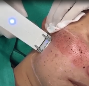 A person is getting their face shaped with an electric device.
