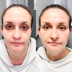 A woman before and after using the new facial wrinkle treatment.
