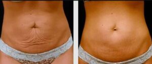 A woman 's stomach before and after surgery.