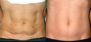 A woman 's stomach and abdomen before and after surgery.