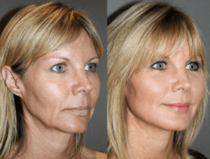 A woman before and after using the botox technique.