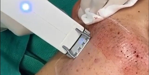 A person is using an electric device to remove the skin.