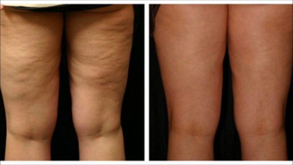 A before and after picture of the legs of two people.