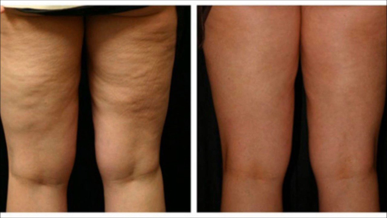 Profound Cellulite Reduction In Cedar Park Body Aesthetics 5174