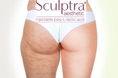 A woman 's buttocks with cellulite and liposuction.