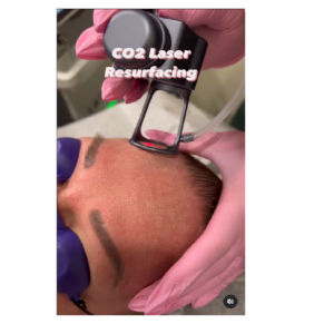A person getting their face laser resurfacing done.