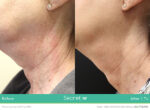 A woman 's neck before and after using the laser.