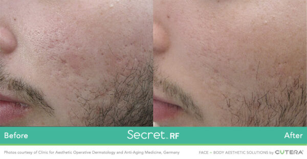 A man with a beard and mustache is shown before and after using the secret rf device.