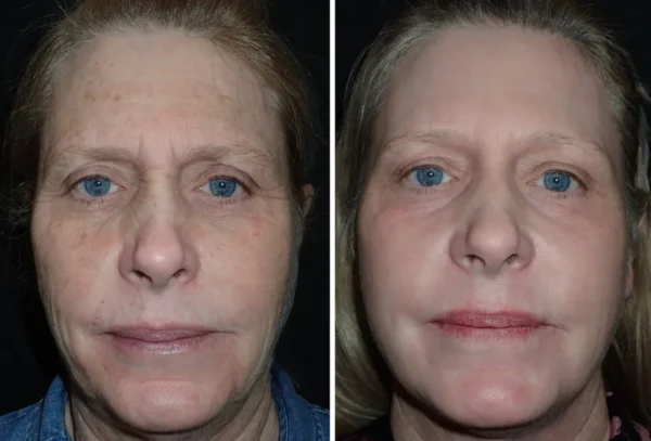 A woman with blue eyes and brown hair is before and after using the procedure.