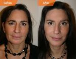 A before and after picture of a woman 's face.