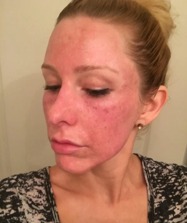A woman with red spots on her face.