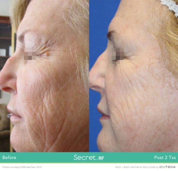 A before and after photo of an older woman 's face.