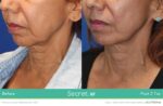 A woman 's face before and after using the secret rf device.