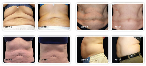 A man 's stomach before and after liposuction.
