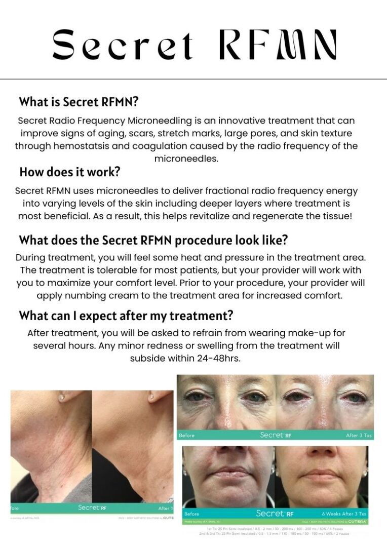 Secret RF microneedling before and after results.