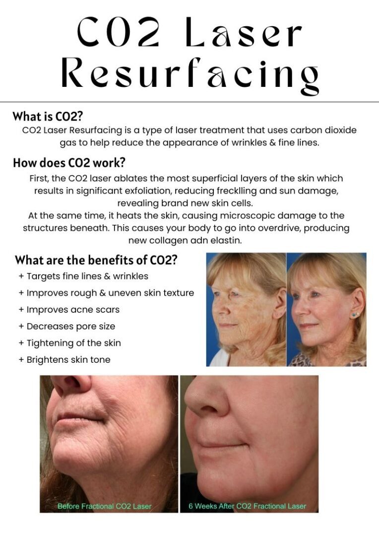 Before and after CO2 fractional laser treatment.